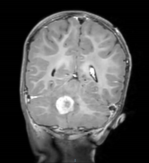 Figura 4. Imagen de resonancia magnética en corte frontal donde se visualiza el tumor de fosa posterior.