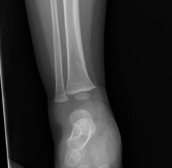 Figura 1. Fractura de Toddler en tibia distal derecha.