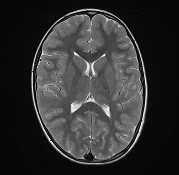 Figura 1. Resonancia magnética de la paciente en la que no se evidencian hallazgos patológicos.