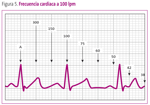 Figura 5. Frecuencia cardiaca a 100 lpm