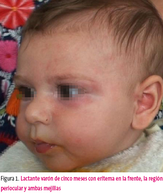 Figura 1. Lactante varón de cinco meses con eritema en la frente, la región periocular y ambas mejillas