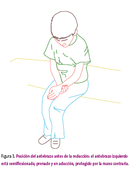 Figura 3. Posición del antebrazo antes de la reducción: el antebrazo izquierdo está semiflexionado, pronado y en aducción, protegido por la mano contraria.
