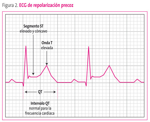 Figura 2. ECG de repolarización precoz