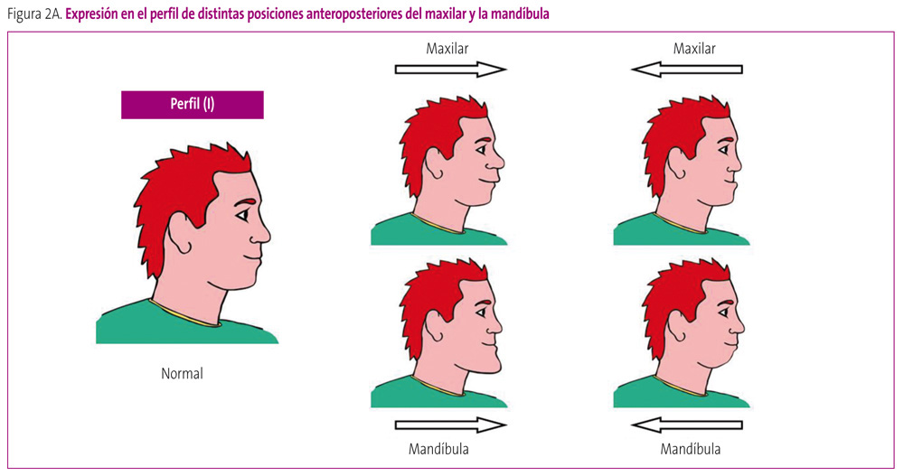 Figura 2A. Expresión en el perfil de distintas posiciones anteroposteriores del maxilar y la mandíbula