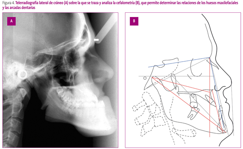 Figura 4. Telerradiografía lateral de cráneo (A) sobre la que se traza y analiza la cefalometría (B), que permite determinar las relaciones de los huesos maxilofaciales y las arcadas dentarias