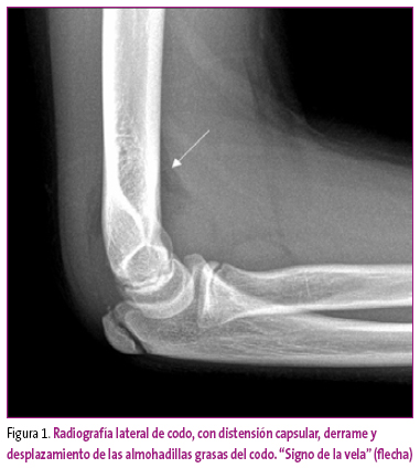 Figura 1. Radiografía lateral de codo, con distensión capsular, derrame y desplazamiento de las almohadillas grasas del codo. “Signo de la vela” (flecha)