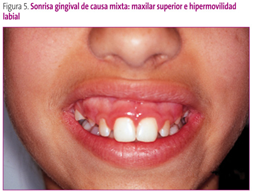 Figura 5. Sonrisa gingival de causa mixta: maxilar superior e hipermovilidad labial