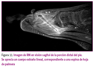 Figura 11. Imagen de RM en visión sagital de la porción distal del pie. Se aprecia un cuerpo extraño lineal, correspondiente a una espina de hoja de palmera