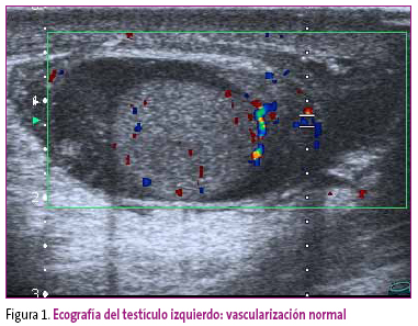 Figura 1. Ecografía del testículo izquierdo: vascularización normal