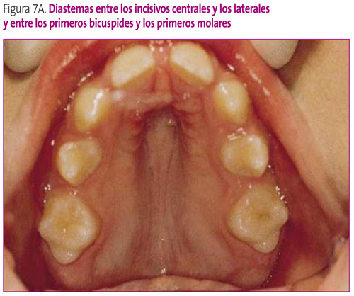 Figura 7A. Diastemas entre los incisivos centrales y los laterales y entre los primeros bicuspides y los primeros molares