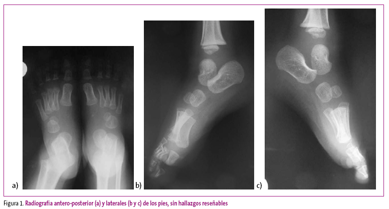 Figura 1. Radiografía antero-posterior (a) y laterales (b y c) de los pies, sin hallazgos reseñables