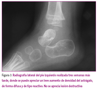 Figura 3. Radiografía lateral del pie izquierdo realizada tres semanas más tarde, donde se puede apreciar un leve aumento de densidad del astrágalo, de forma difusa y de tipo reactivo. No se aprecia lesión destructiva