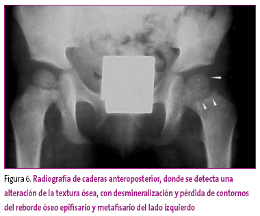 Figura 6. Radiografía de caderas anteroposterior, donde se detecta una alteración de la textura ósea, con desmineralización y pérdida de contornos del reborde óseo epifisario y metafisario del lado izquierdo