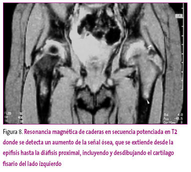 Figura 8. Resonancia magnética de caderas en secuencia potenciada en T2 donde se detecta un aumento de la señal ósea, que se extiende desde la epífisis hasta la diáfisis proximal, incluyendo y desdibujando el cartílago fisario del lado izquierdo