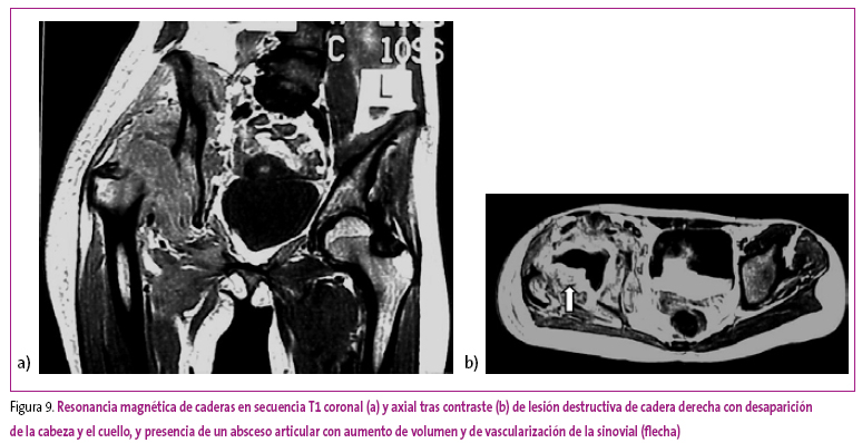 Figura 9. Resonancia magnética de caderas en secuencia T1 coronal (a) y axial tras contraste (b) de lesión destructiva de cadera derecha con desaparición de la cabeza y el cuello, y presencia de un absceso articular con aumento de volumen y de vascularización de la sinovial (flecha)