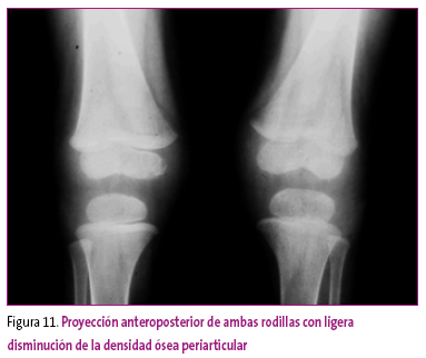Figura 11. Proyección anteroposterior de ambas rodillas con ligera disminución de la densidad ósea periarticular