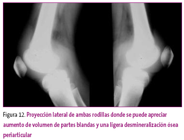 Figura 12. Proyección lateral de ambas rodillas donde se puede apreciar aumento de volumen de partes blandas y una ligera desmineralización ósea periarticular