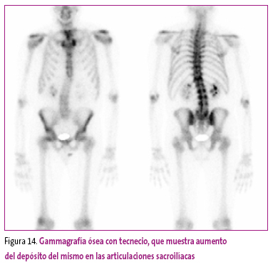 Figura 14. Gammagrafía ósea con tecnecio, que muestra aumento del depósito del mismo en las articulaciones sacroilíacas