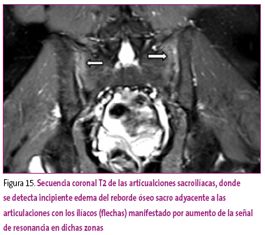 Figura 15. Secuencia coronal T2 de las articualciones sacroilíacas, donde se detecta incipiente edema del reborde óseo sacro adyacente a las articulaciones con los ilíacos (flechas) manifestado por aumento de la señal de resonancia en dichas zonas