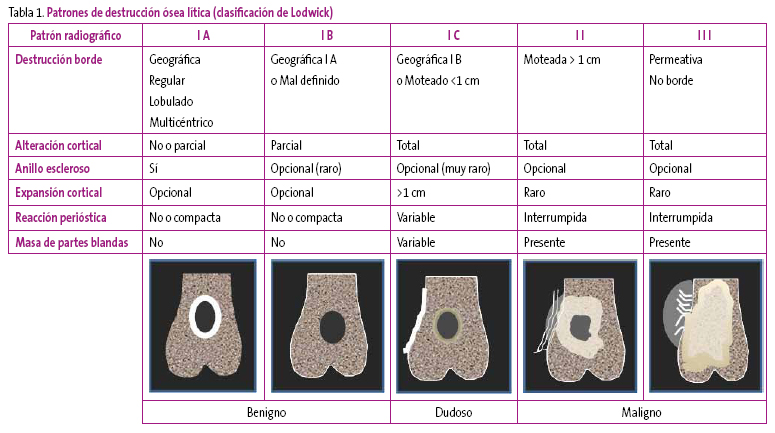 Tabla 1. Patrones de destrucción ósea lítica (clasificación de Lodwick)	