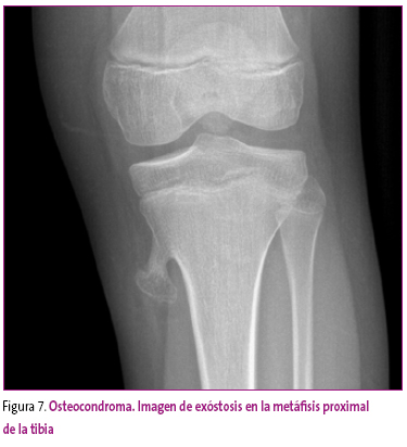 Figura 7. Osteocondroma. Imagen de exóstosis en la metáfisis proximal de la tibia
