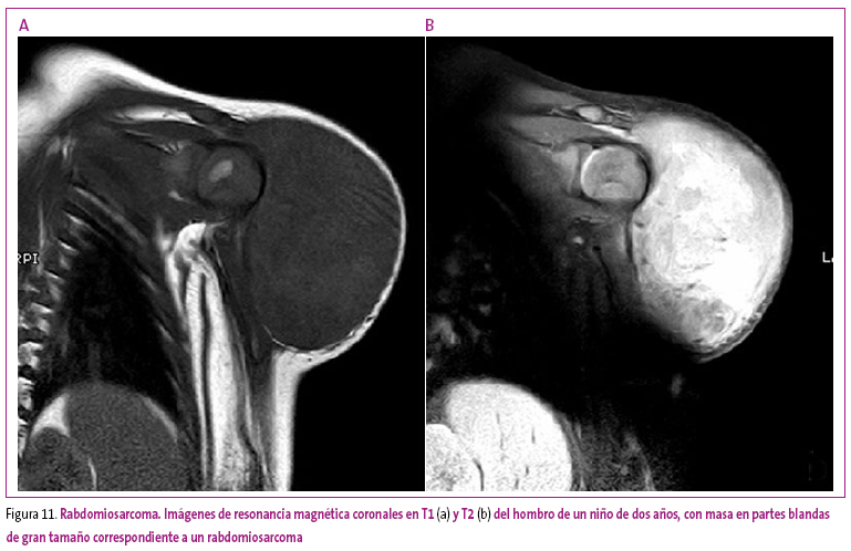 Figura 11. Rabdomiosarcoma. Imágenes de resonancia magnética coronales en T1 (a) y T2 (b) del hombro de un niño de dos años, con masa en partes blandas de gran tamaño correspondiente a un rabdomiosarcoma