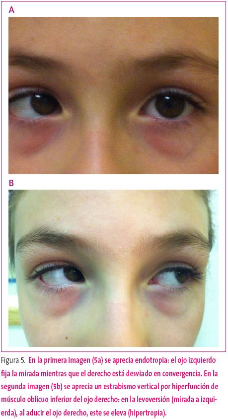 Figura 5. En la primera imagen (5a) se aprecia endotropia.En la segunda imagen (5b) se aprecia un estrabismo vertical por hiperfunción de músculo oblicuo inferior del ojo derecho