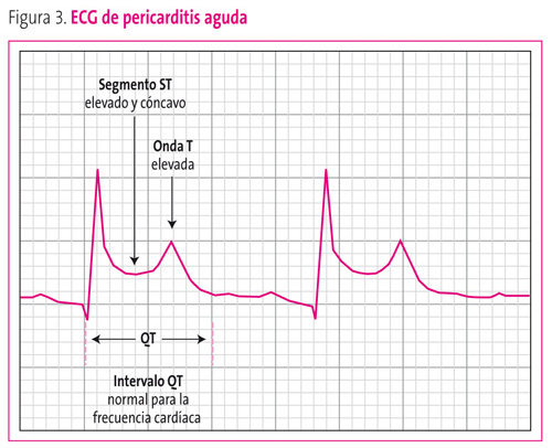 Figura 3. ECG de pericarditis aguda