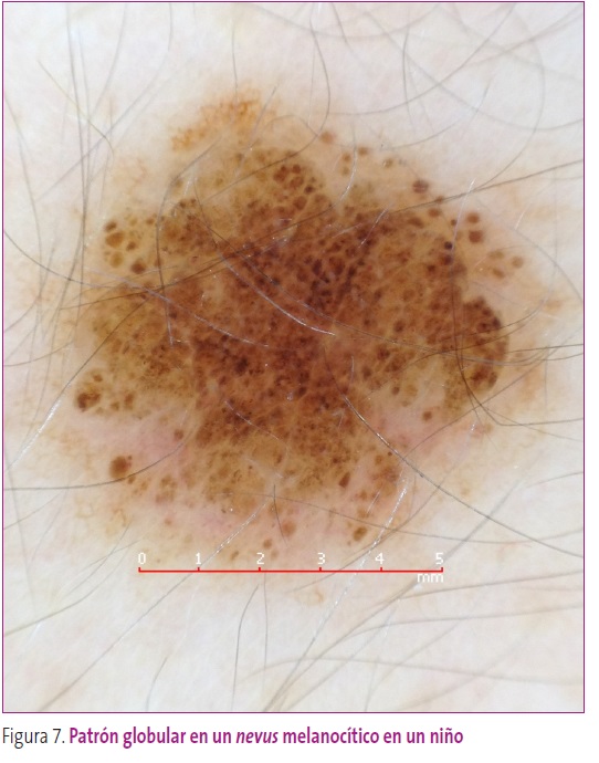 Figura 7. Patrón globular en un nevus melanocítico en un niño.