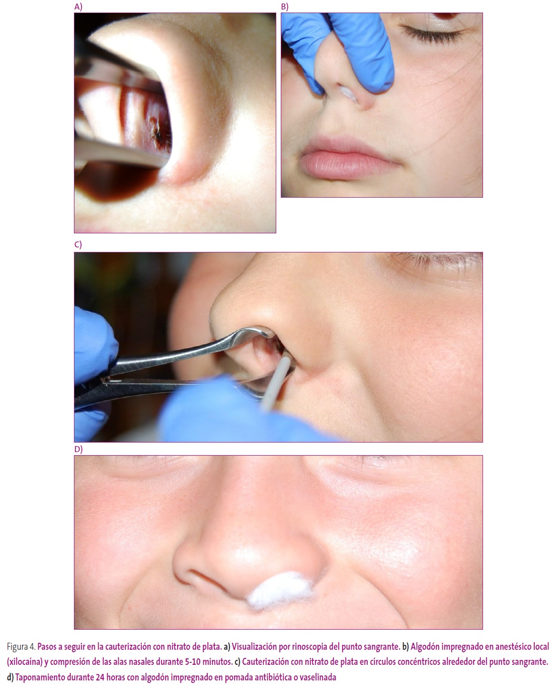 Figura 4. Taponamiento combinado por compresión sublabial y nasal