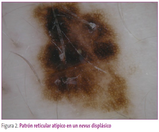 Figura 2. Patrón reticular atípico en un nevus displásico.